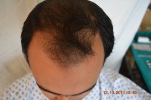Cheap hair transplant in Germany