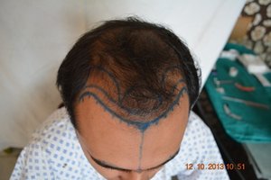 Hair Transplant Germany
