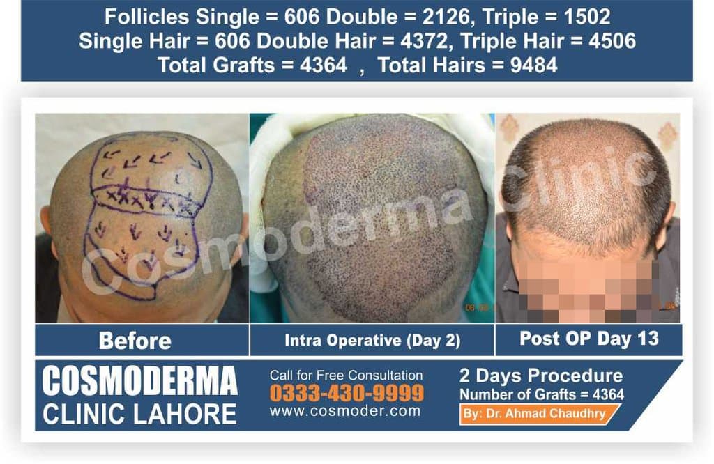 Real hair patch Lahore