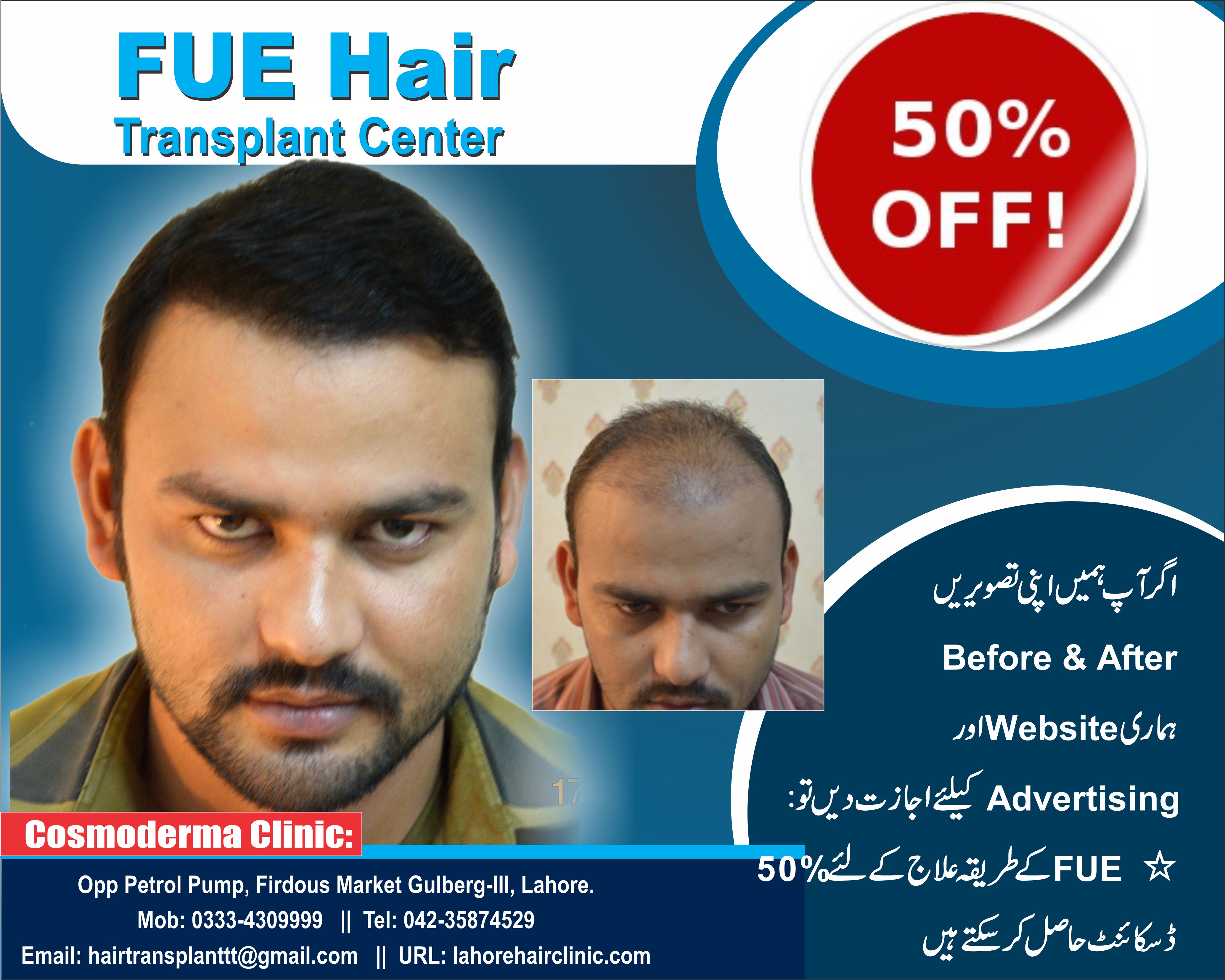 average cost of hair transplant in pakistan