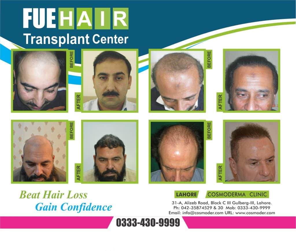Fue hair transplant results Pakistan
