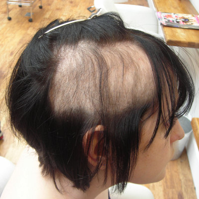 tricotillomania treatment in Lahore