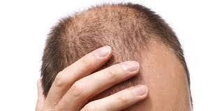 Androgenetic alopecia treatment in Lahore Pakistan 