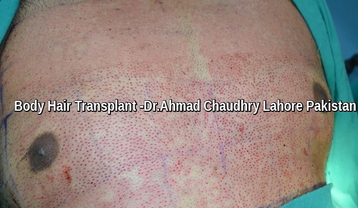 Body hair transplant Lahore 